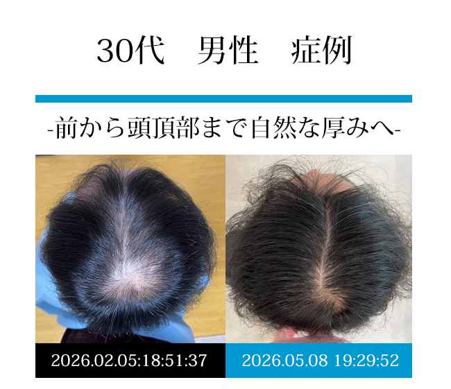 30代男性の発毛症例写真