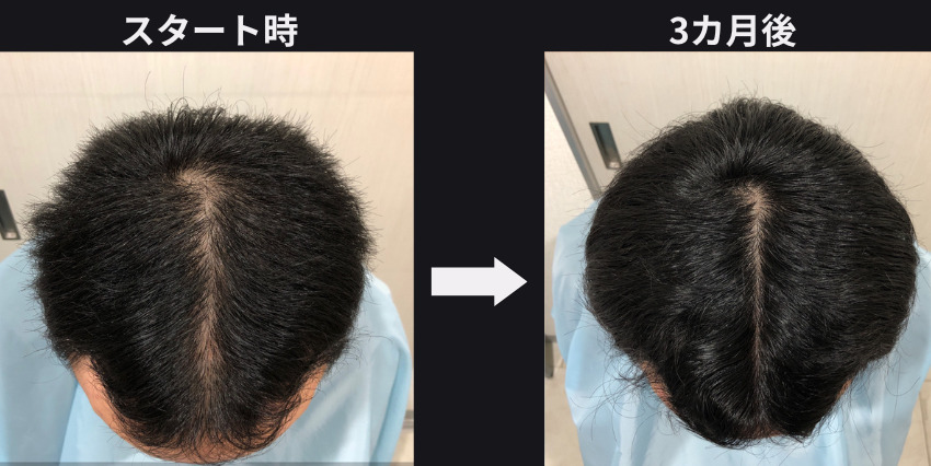 ハゲる前兆を感じたら、すぐに対策を!! | 薄毛AGAの発毛サロンならスーパースカルプ発毛センター鹿児島中央店へ!